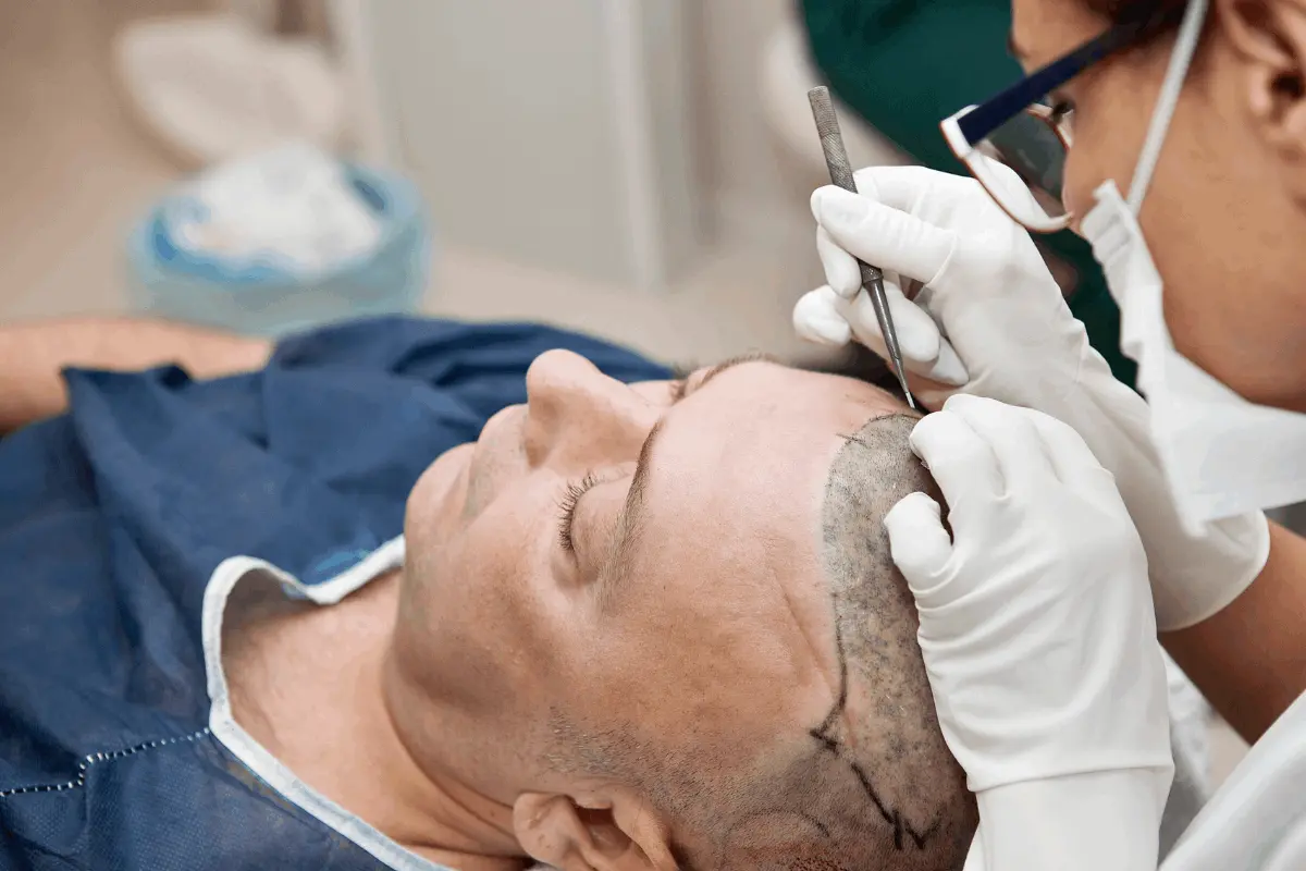 Autotrapianto Capelli