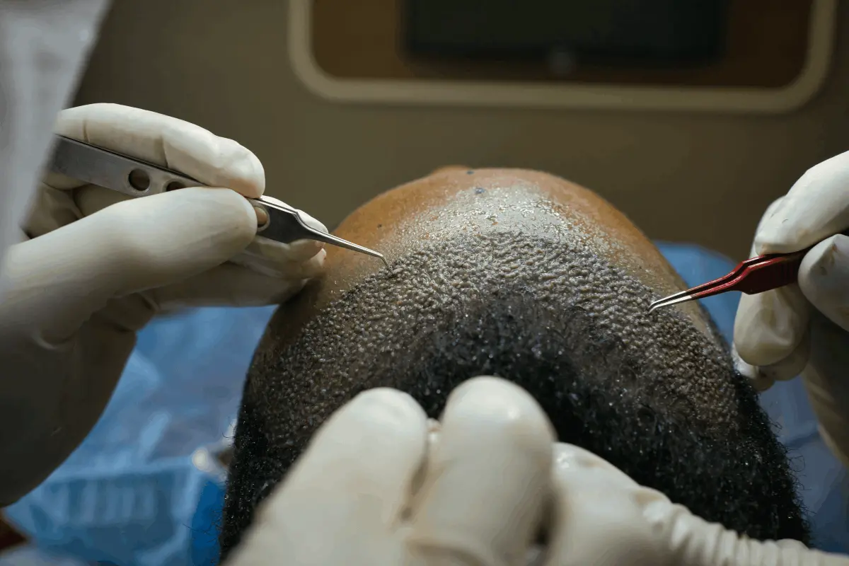 Autotrapianto Capelli