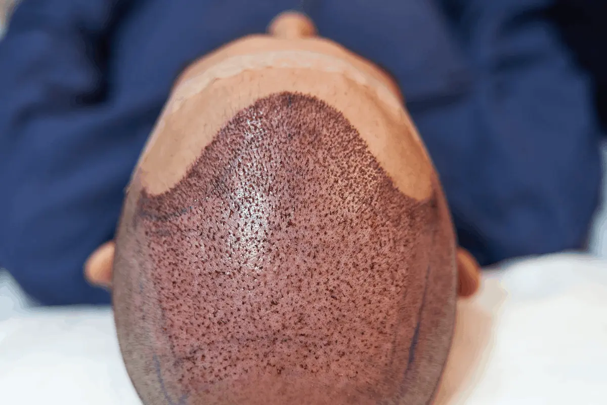 Autotrapianto Capelli