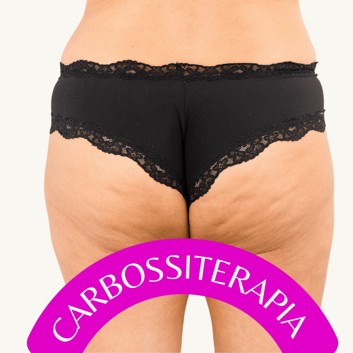 Carbossiterapia